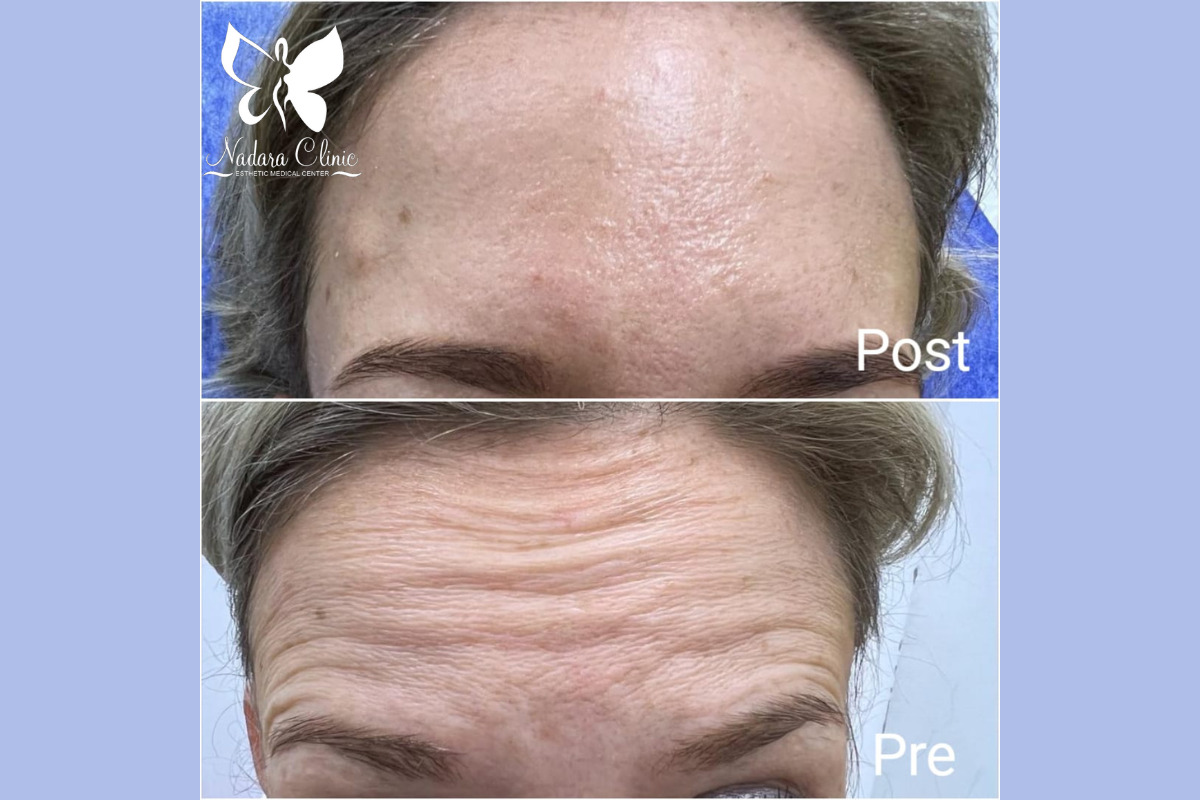 Botox clinic in Hurghada